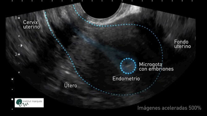 El útero se mueve para que los embriones se implanten correctamente -  InvitroTV